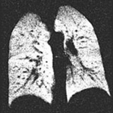 Picture of the lung obtained by NMR of inhaled optically pumped He3 (Courtesy of E. Otten and W. Heil, University of Mainz).